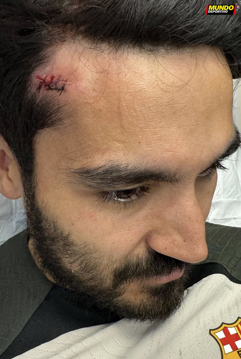 Barcelona Kehilangan Pemain Kunci Karena Cedera, Salah Satunya Pedri foto gundugan cedera