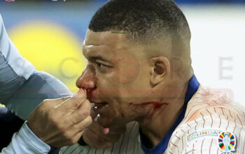 Insiden Patah Hidung Kylian Mbappe di Euro 2024